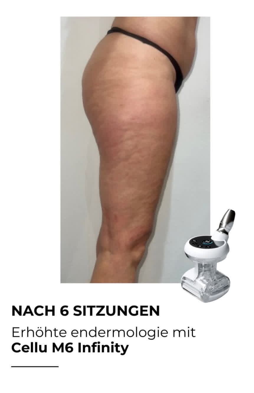 LPG Endermologie