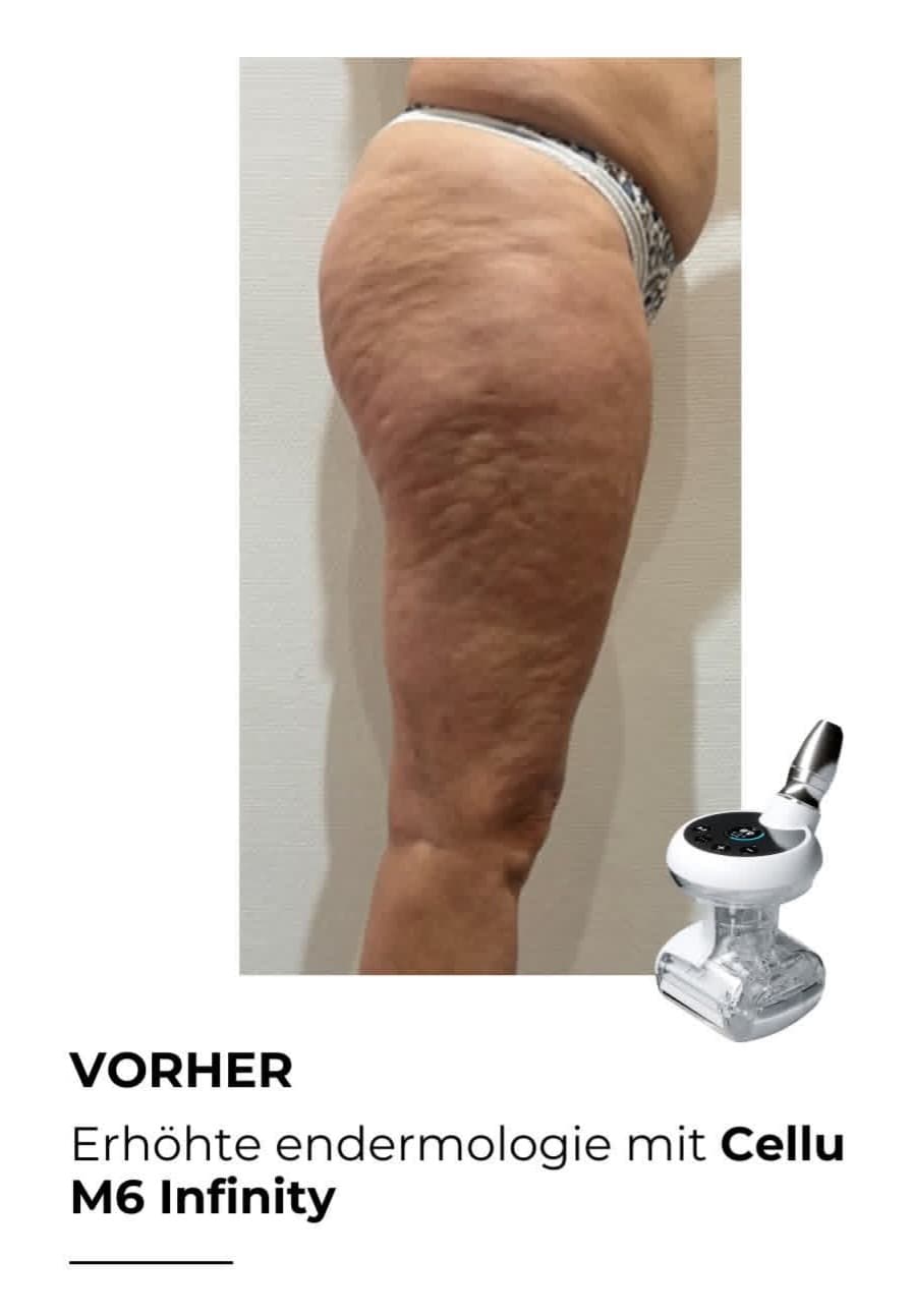 LPG Endermologie